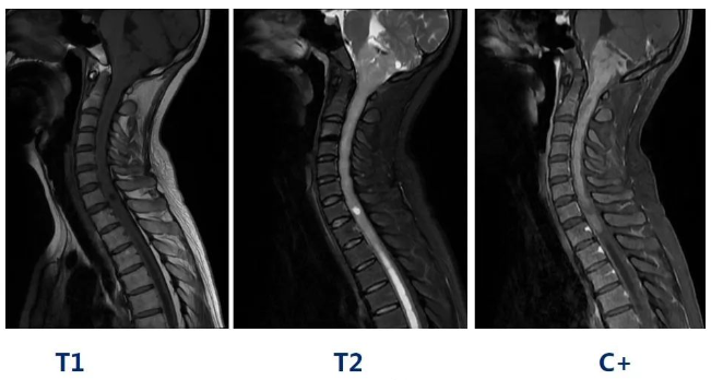 术前MRI