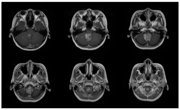 术前MRI