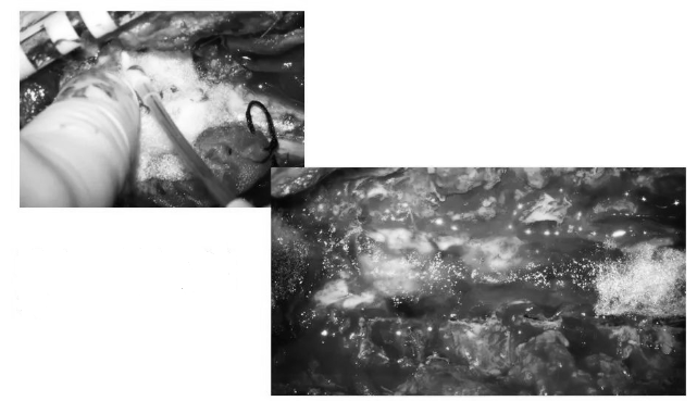 硬膜表面铺盖速即棉后生物胶水再次覆盖，防止脑脊液漏