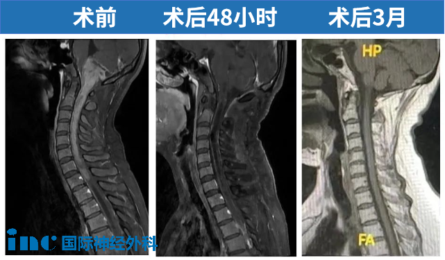 术前术后MRI对比