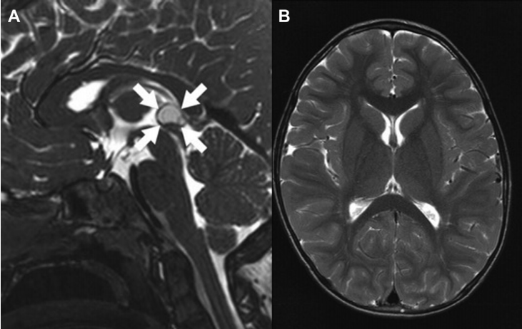 术前MRI
