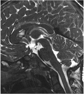 术后MRI