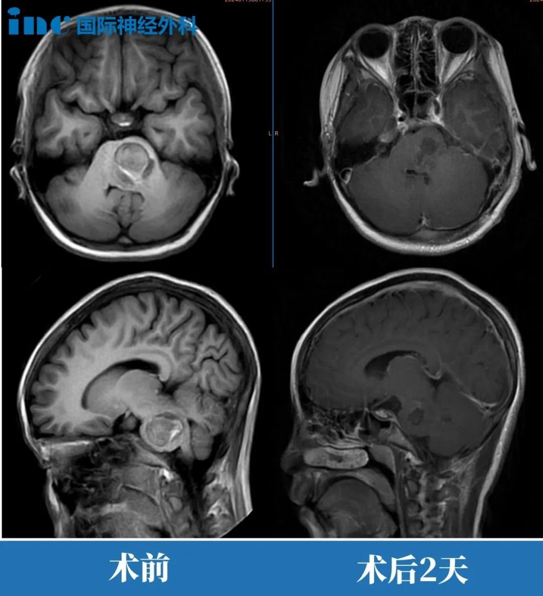 MRI