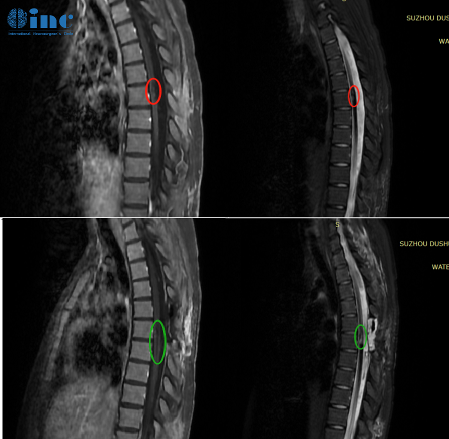 MRI