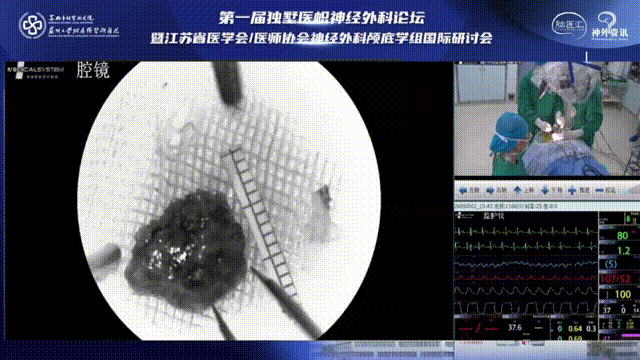 巴教授脑干延髓示范手术直播情况：肿瘤取出画面