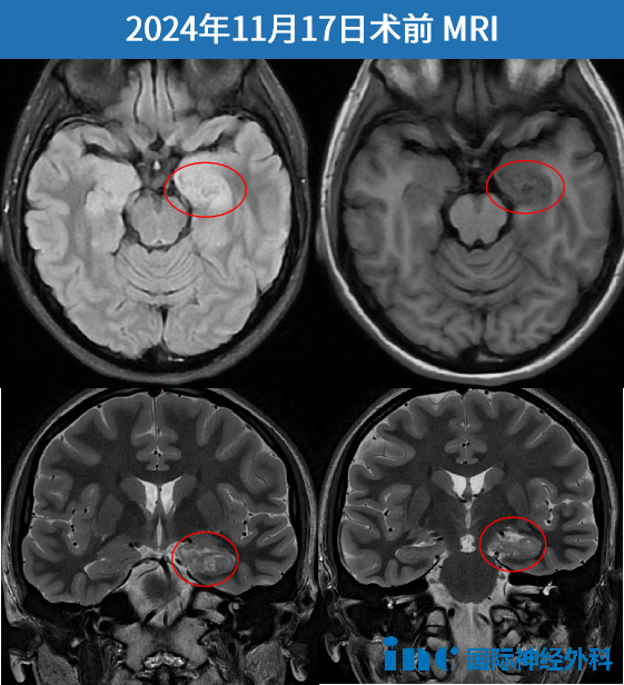 术前MRI
