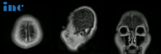 术前MRI：肿瘤体积巨大，广泛累及颅底结构，侵蚀斜坡、鞍内鞍上、海绵窦区，包裹右侧颈内动脉。肿瘤向上推挤视神经、视交叉，到达三脑室底部；向后上方推挤脑干和基底动脉，部分肿瘤边缘与脑干分界欠清。
