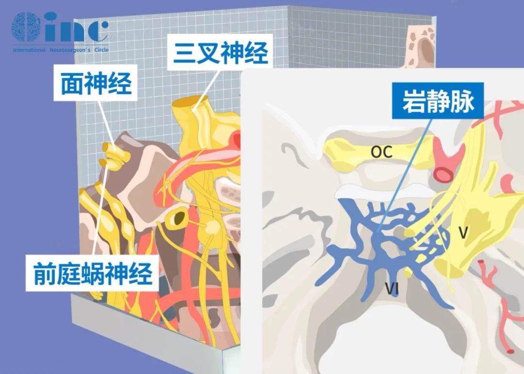 听神经瘤是桥小脑角区(CPA区)常见的肿瘤，肿瘤通常会压迫周围许多重要神经血管、小脑甚至脑干，尤其大肿瘤，手术难度大，手术不慎易遗留肢体瘫痪、面瘫、听力损伤等。