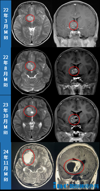 MRI影像