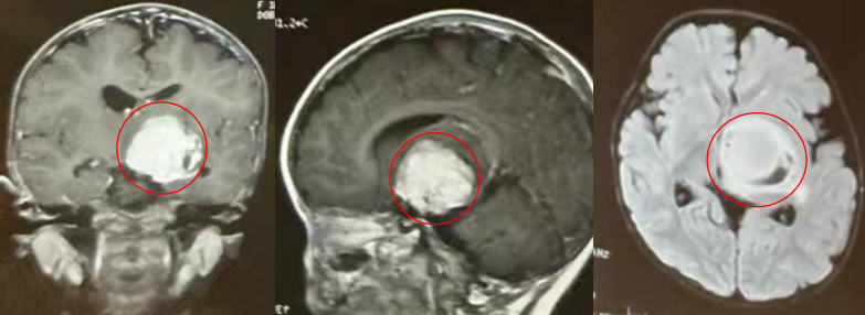 面对多数儿童脑肿瘤，手术往往是能够彻底清除病灶、为孩子赢得生存希望的治疗手段。