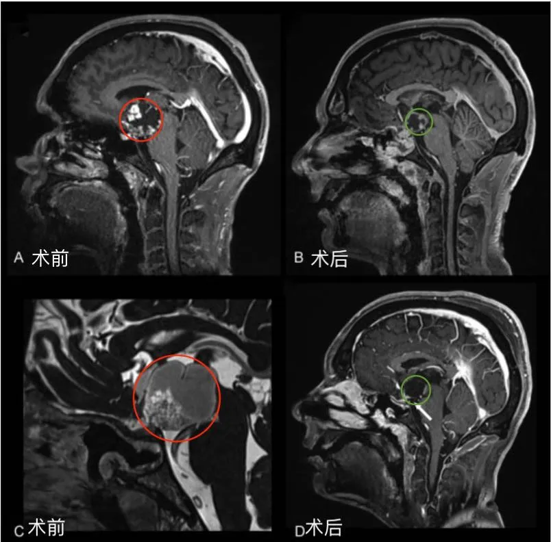 术前(A，C)和术后(B, D)矢状位增强MR对比，显示肿瘤全切。