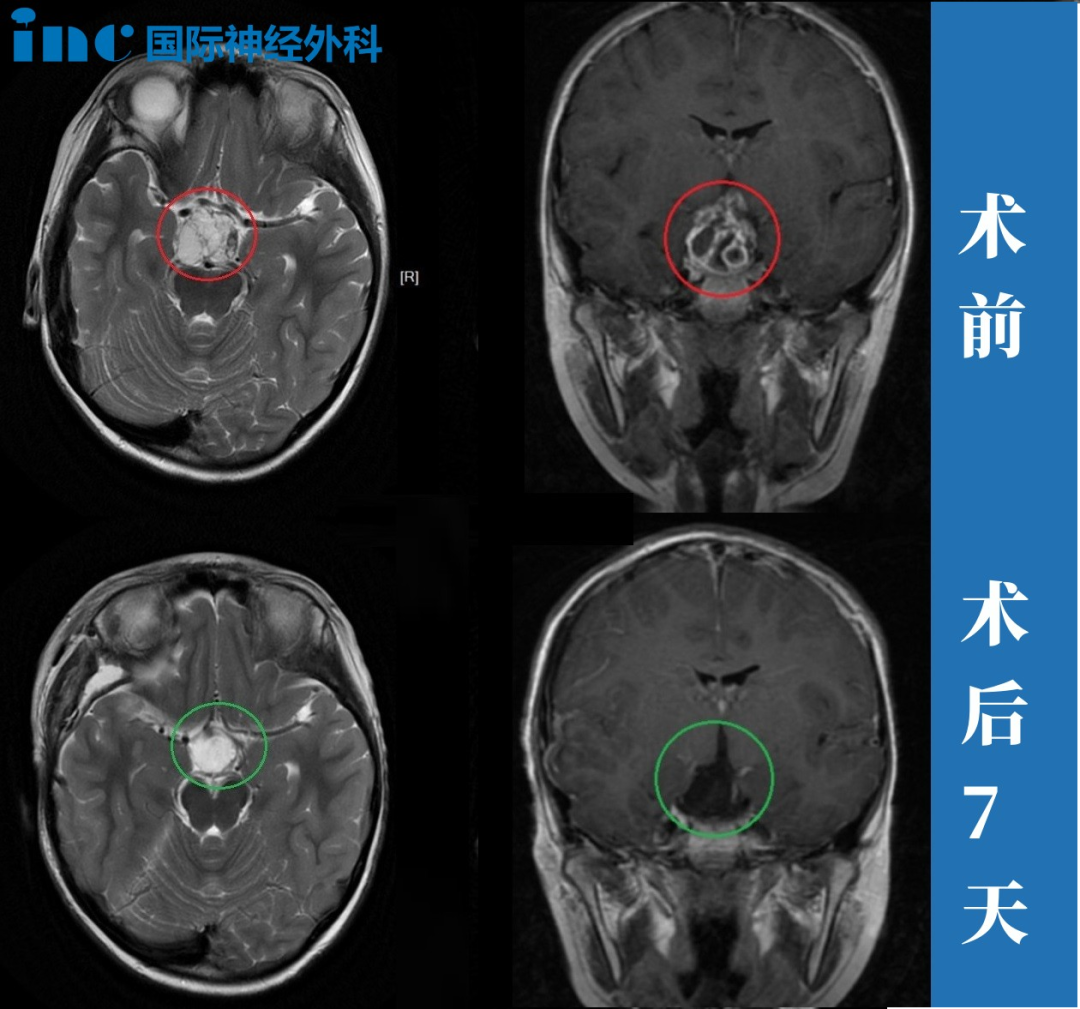 术前术后MRI影像
