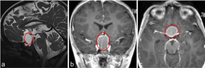 a–c图MR成像显示囊性病变对比增强，高度怀疑颅咽管瘤;j、k、l图显示，肿瘤得到全切。