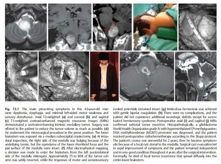 《adult brainstem glioma》（成人脑干胶质瘤）
