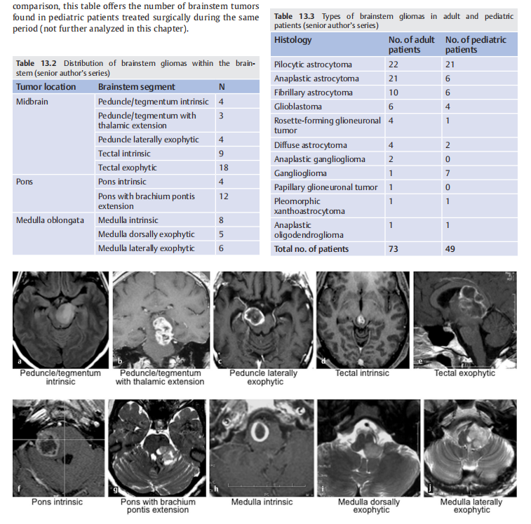 《adult brainstem glioma》（成人脑干胶质瘤）