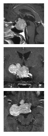 磁共振成像(MRI)检查揭示了一个位于右侧、紧靠垂体区域的大型垂体腺瘤，并且该肿瘤在注射对比剂后呈现吸收现象。