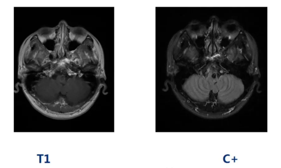术前MRI