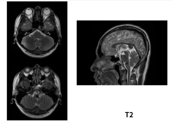 术前MRI