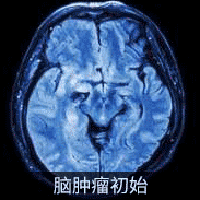 脑肿瘤拖延治疗可能很快恶化