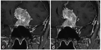 该患者停止服药后的磁共振成像(MRI)影像