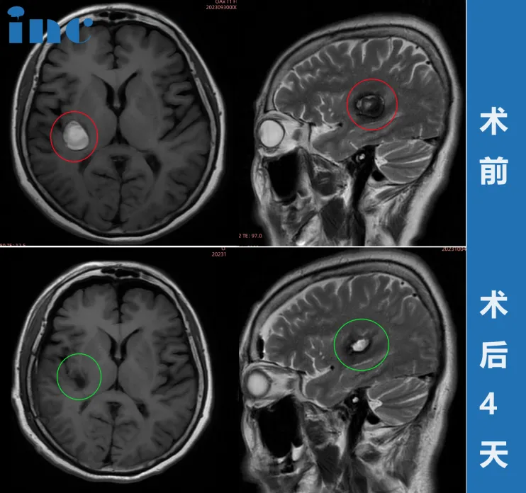 术前术后MRI影像