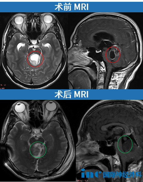 术前术后MRI影像