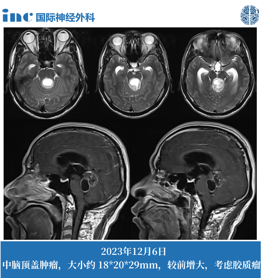 MRI影像