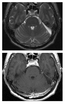 术后 MRI 图像显示肿瘤已完全切除。