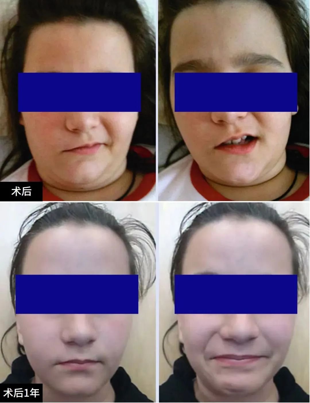 Elena术前术后对比