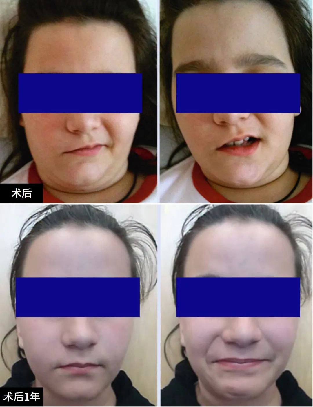 术后13天患者恢复出院。12个月后的随访检查显示，她的面神经有明显恢复。