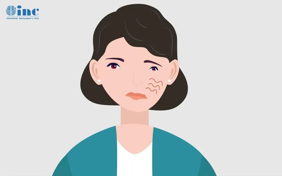如果患者面神经的颅内段或颞骨段受到损伤，如：乳突区的病变累及面神经垂直段，同时面神经远端良好，可以采取面神经远端与其邻近的颅神经吻合，如：舌下神经或副神经等。