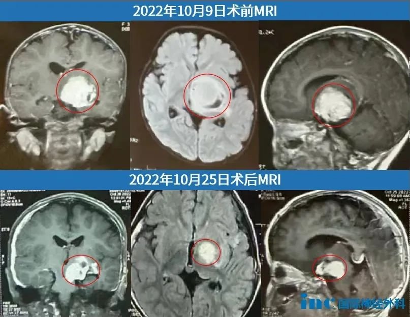 第一次术前术后影像对比