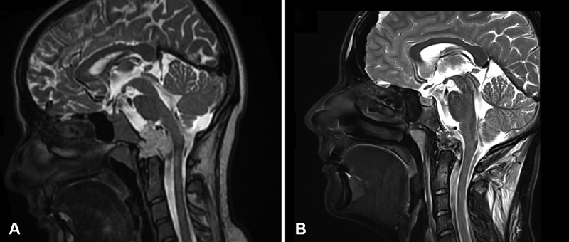 图1，术前和术后磁共振成像(MRI)。(A)术前矢状面t2加权MRI显示以颅颈交界区为中心的高信号病变（脊索瘤），伴有硬膜内延伸和神经血管结构受压。(B) 术后矢状 T2 加权 MRI 显示肿瘤实现了全切。