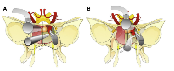 (A) Binostril 和 (B) 使用有角度器械的单鼻孔入路。旋转轴与吸力角度相结合，导致手指的小动作在曝光深度上被放大，并允许 360 度范围。当用拇指和中指和无名指控制时，吸力还可以沿前后方向移动。