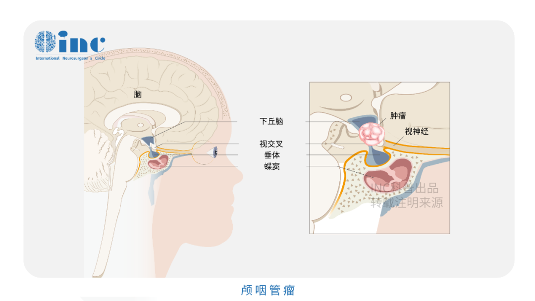 INC国际福教授颅咽管瘤35岁全切术后视力改善