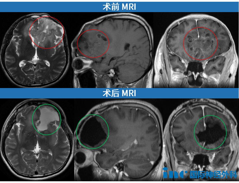 术前术后MRI
