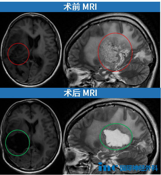 术前术后MRI