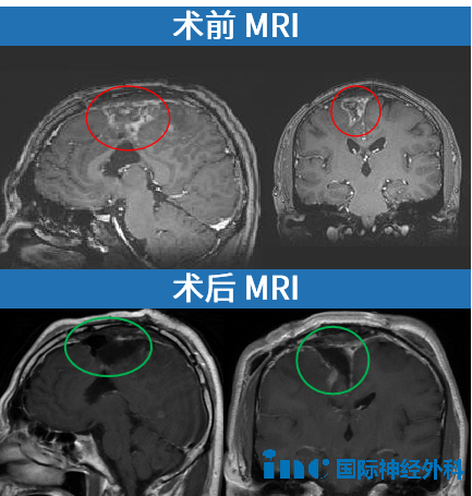 术前术后MRI