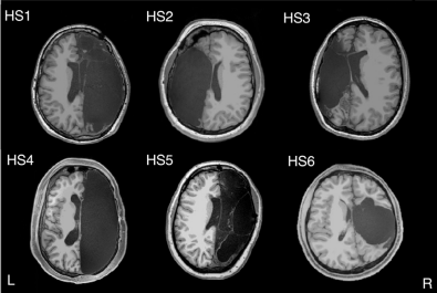 接受大脑半球切除术后的 MRI