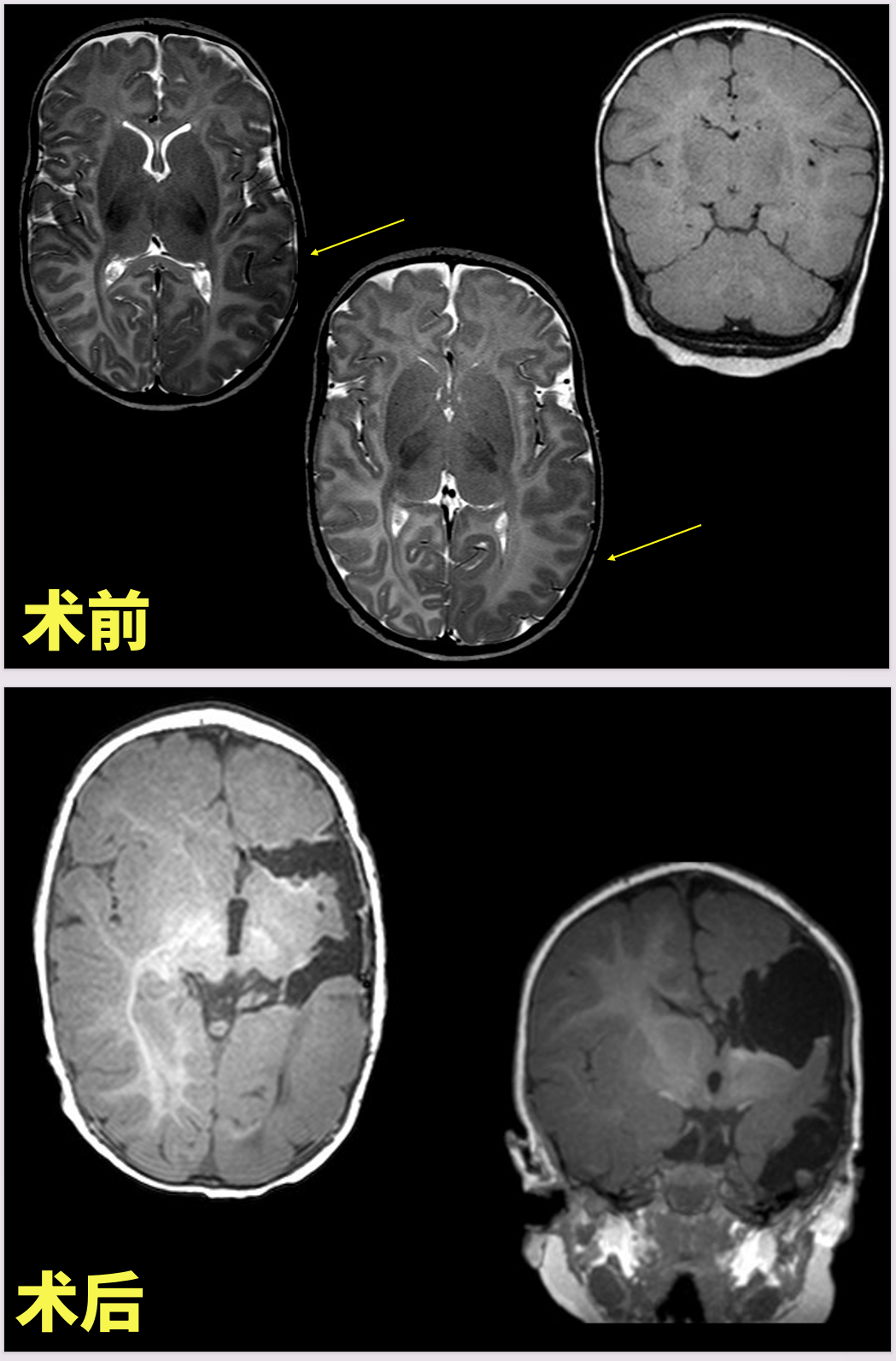 术前术后MRI