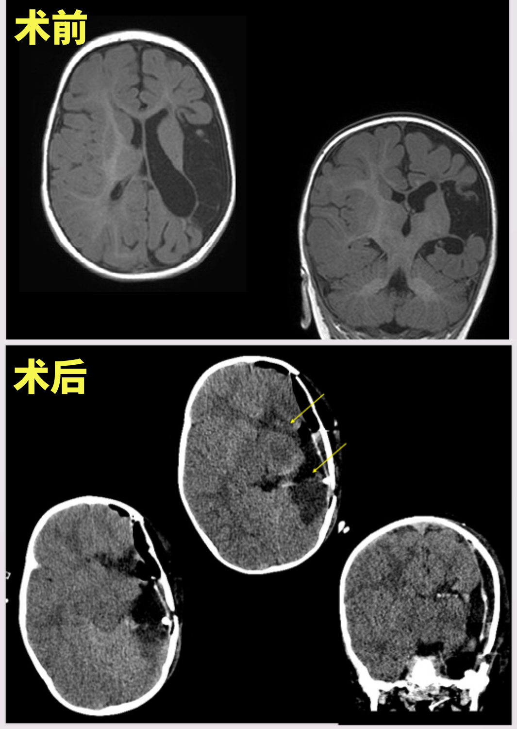  癫痫发作致大脑中动脉梗死