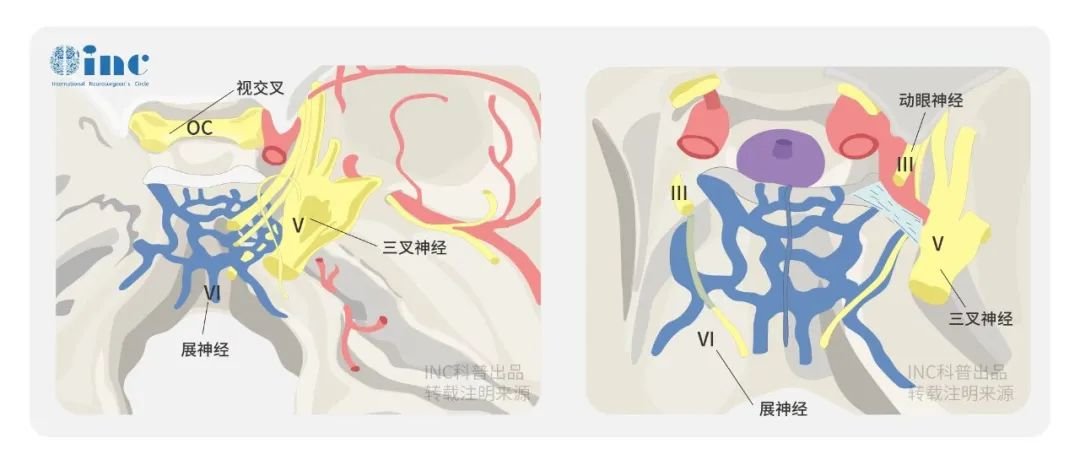 Henry的巨大岩斜区脑膜瘤手术治疗难度非常大，不仅是由于其位置“深藏不露”，岩斜区这个神秘的地带，藏身于头骨的深处，在颞骨岩部和枕骨斜坡的交汇处，从岩骨尖一直延伸到颈静脉孔；还有着众多“不可冒犯”的邻居，如第Ⅴ、 Ⅶ 和 Ⅷ 脑神经、底下的颈静脉孔水平线、下面紧邻的枕骨大孔区等。