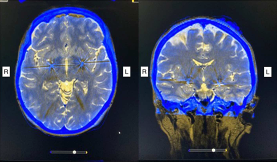 术后立体定向 CT 成像与术前 MRI 扫描融合显示双侧电极放置在后腹侧苍白球内侧。