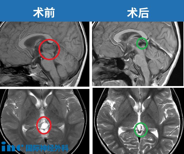 6岁男孩-松果体占位性病变