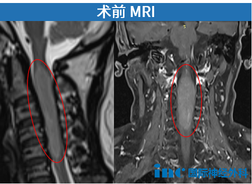 MRI影像