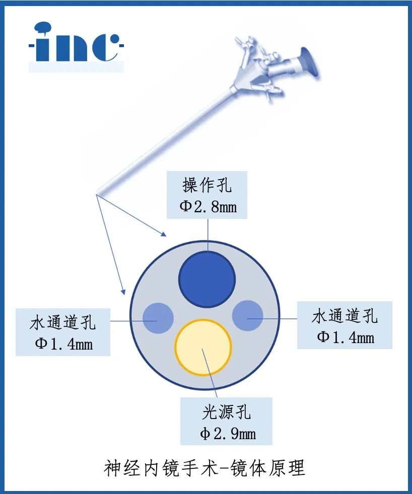神经内镜手术
