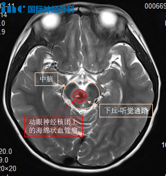 INC巴教授主刀、国内神经外科医生团队全力配合下，突破“生命禁区”，为她顺利示范手术。
