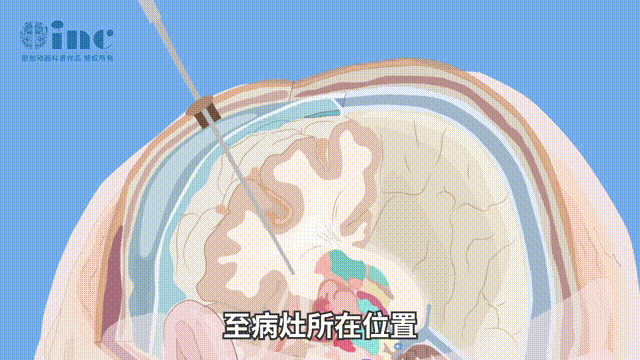 LITT在颅内疾病的治疗中越来越受到欢迎，包括儿童神经肿瘤和癫痫。