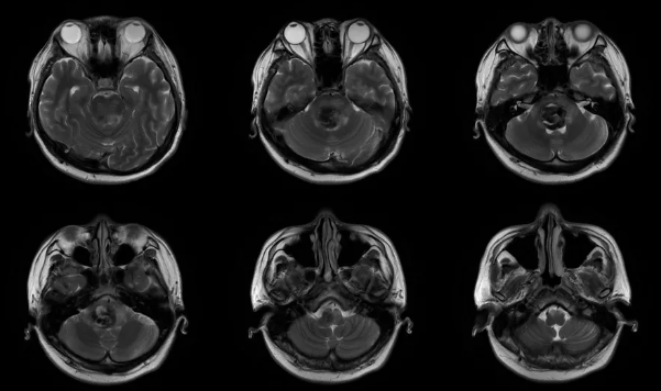 ▼术前MRI