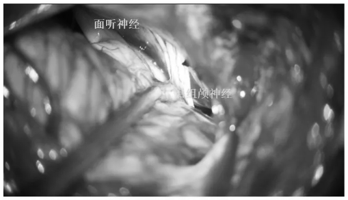 充分显露后组颅神经、面听神经及绒球